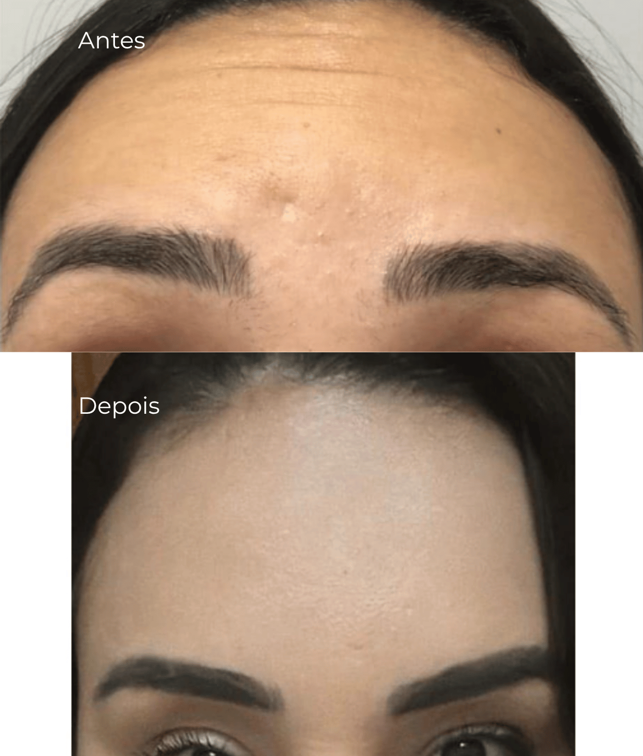 Antes e Depois - Botox Toxina Botulínica Donna Belíssima
